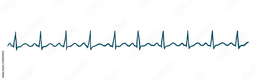 Ecg image shows normal sinüs rhythm Stock Illustration | Adobe Stock