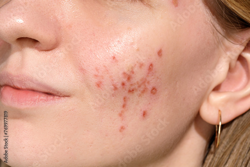 Skin healing period after erbium laser facial resurfacing. Young woman suffering from problem skin. Treatment of ice pick scars. Day 1.