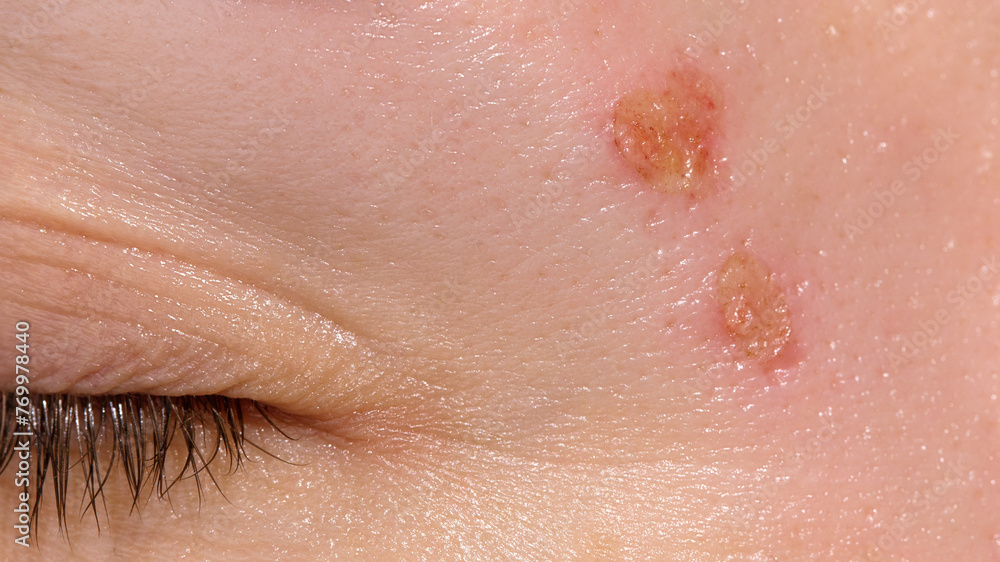 Fototapeta premium Skin healing period after erbium laser facial resurfacing. Young woman suffering from problem skin. Treatment of ice pick scars. Day 1.