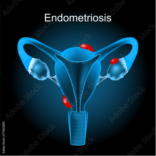 Endometriosis. Cross section of a human uterus