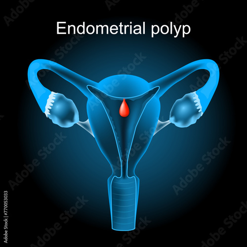 Endometrial polyp. Cross section of a human uterus with Uterine polyp