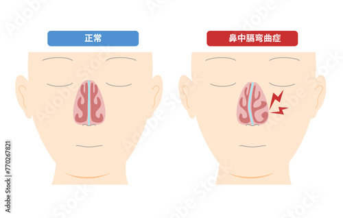 鼻中膈の変形によって起こる鼻中膈弯曲症のイラスト photo