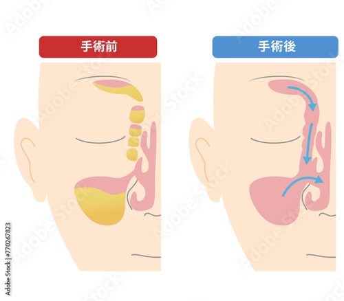 内視鏡下副鼻腔手術（ESS）のやり方と手術前の比較図