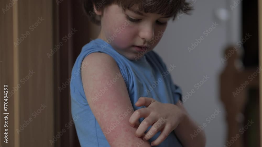 Bruised Rash Child Scratching Red Rash on Hand. Boy Scratches Atopic Skin ...