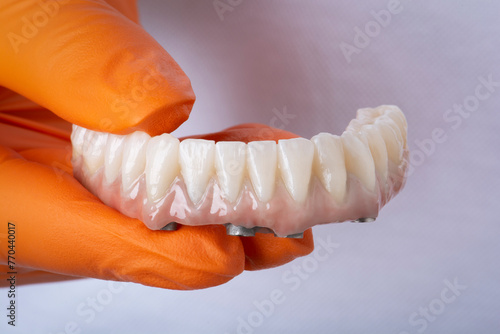 Zirconia crowns on titanium bar.  Total rehabilitation on implants.