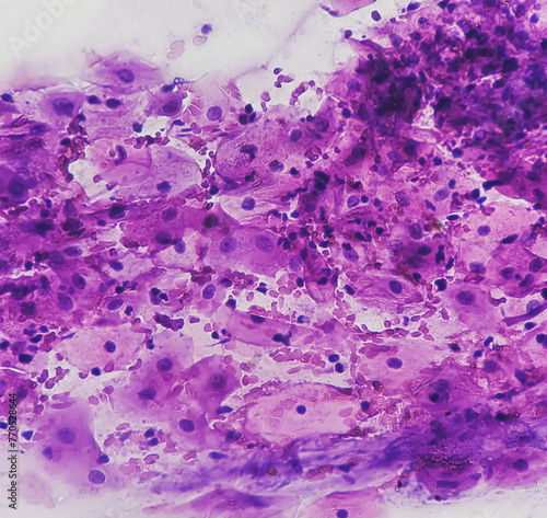 Light micrograph of a vaginal smear showing adenocarcinoma cells (center). Vaginal cancer. Inflammatory smear with HPV related changes. Cervical cancer. SCC.