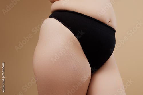 Stretch marks on female legs. A woman's fat cellulite and a stretch mark on her leg. Cellulite. Close up human Skin natural stretch marks Texture. Stretch mark woman belly