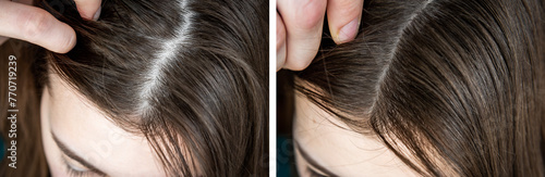 Close up of woman with hair loss problem. Before and after treatment. photo