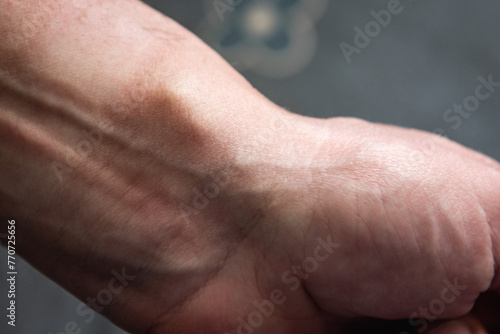 Female hand with a hygroma or wrist ganglion cyst. photo