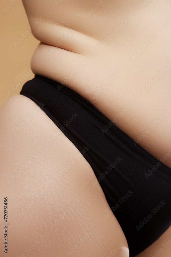 Closeup Stretch marks on female legs. A woman's fat cellulite and a stretch mark on her leg. Cellulite. Close up human Skin natural stretch marks Texture. Stretch mark woman belly