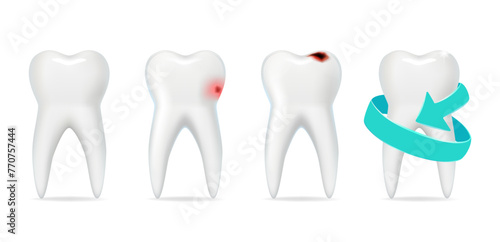 Healthy and diseased tooth with caries, tooth protection.