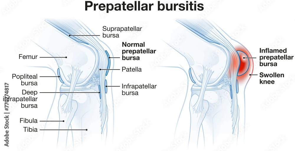 Prepatellar bursitis. Inflammation of the bursa in front of the kneecap. Labeled illustration - obrazy, fototapety, plakaty 