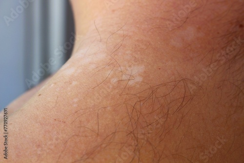 Understanding Tinea Versicolor: Managing and Treating Pityriasis Versicolor photo