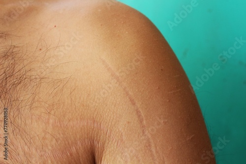 Embracing Change: Understanding and Treating Stretch Marks on Male Arms and Chest