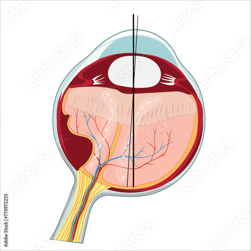 eye detachment problem vector