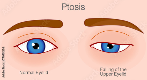 Ptosis, falling eye upper eyelid droop over eye. Droopy, lazy eye. Skin color back. Vector illustration