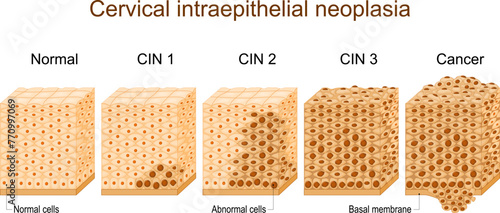 Cervical dysplasia. Cervical cancer