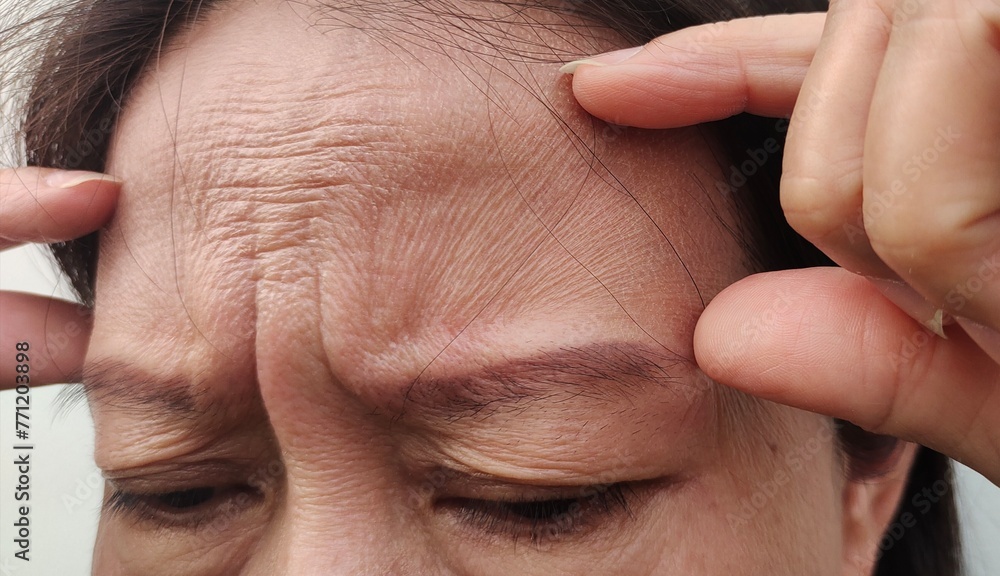 Fototapeta premium close up of a person holding the flabbiness and wrinkle, forehead lines and loose, Flabby skin and dark spots on the face of the woman, health care and beauty concept.
