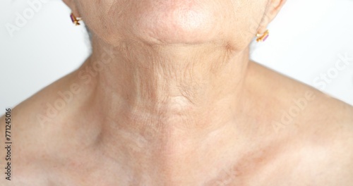 Scar on neck from thyroid removal surgery in senior adult woman. photo