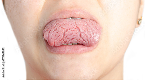 Woman with geographical tongue. Migratory glossitis. photo