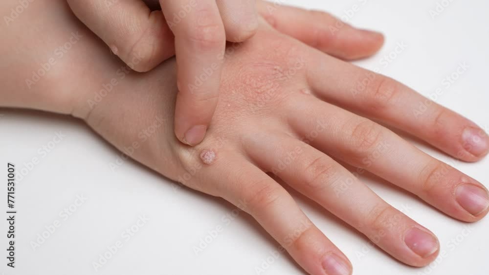Child touches his hand with common viral flat warts Verruca vulgaris, scratches them, close-up. Human papillomavirus, HPV. Pediatric dermatology concept Child touches his hand with common viral flat warts Verruca vulgaris, scratches them, close-up. Human papillomavirus, HPV. Pediatric dermatology concept