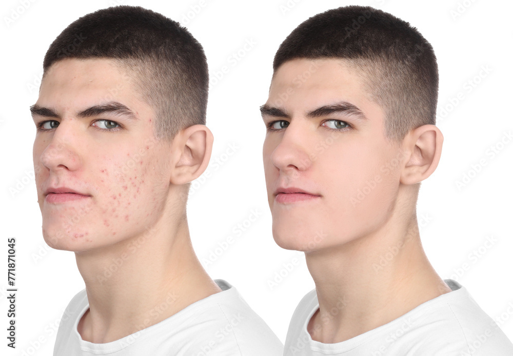Acne problem. Young man before and after treatment on white background, collage of photos