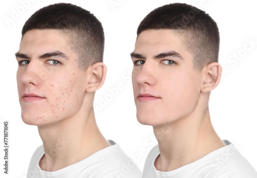 Acne problem. Young man before and after treatment on white background, collage of photos
