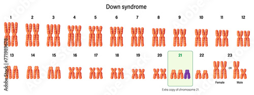 karyotype of Down syndrome. Autosomal abnormalities. Trisomy 21. Genetic disorder caused when abnormal cell division results in an extra full.