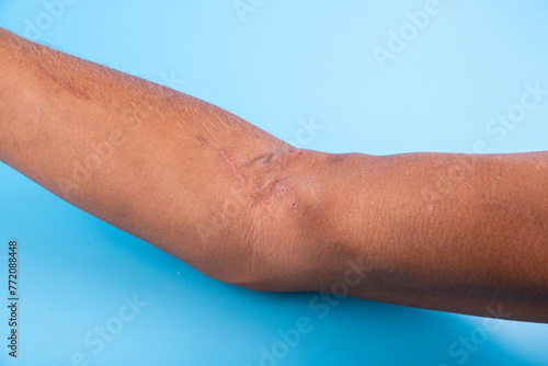 Fistula on the arm as a result of an operation for hemodialysis with kidney failure.