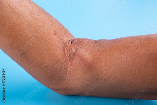 Bild auf Leinwand Fistula on the arm as a result of an operation for hemodialysis with kidney failure