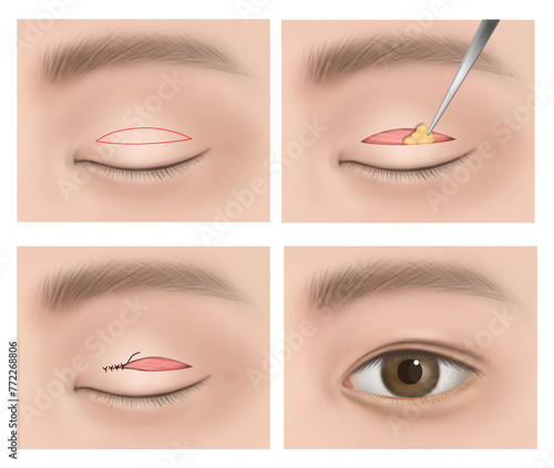 double eyelid operation