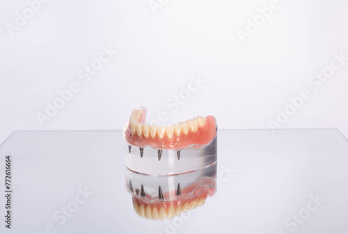 Removable mandibular prosthesis All on 4 system supported by implants.