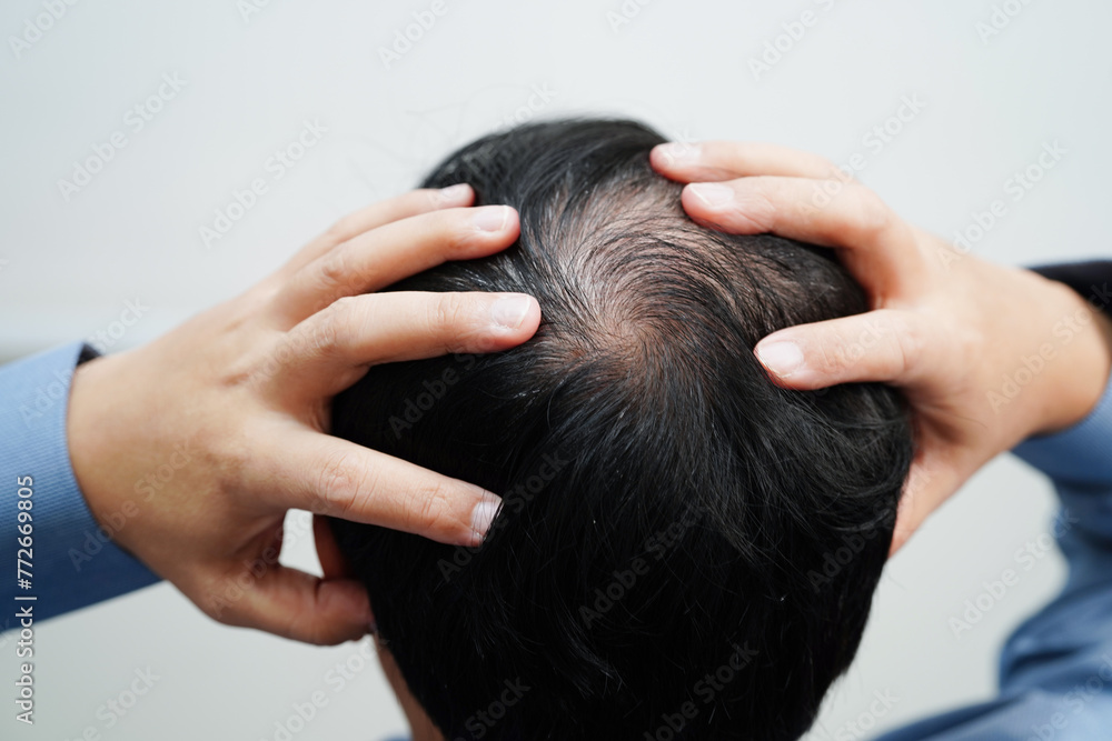 Bald head in man, hair loss treatment health problem. Bald head in man, hair loss treatment health problem.