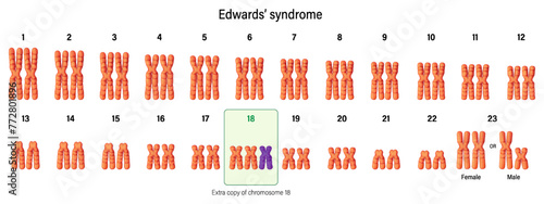 Karyotype of Edwards' syndrome. Autosomal abnormalities. Trisomy 18. Genetic disorder. Chromosome disorder that often results in stillbirth. photo