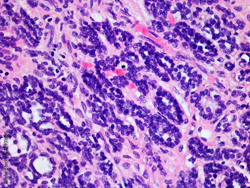 Microscopic Image of a Wilms Tumor or Nephroblastoma of a Childs Kidney Viewed at 400x Magnification with Hematoxylin and Eosin Staining. One of the most Common Cancers Affecting Children photo