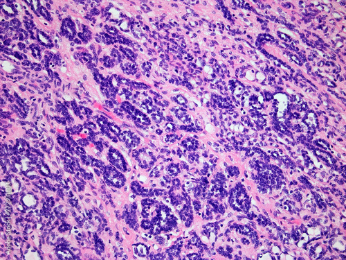 Wilms Tumor or Nephroblastoma of a Childs Kidney Viewed at 200x Magnification with Hematoxylin and Eosin Staining. One of the most Common Cancers Affecting Children