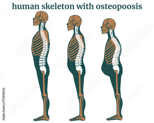 Destruction of the human spine due to osteoporosis. Reduced height, body deformation. Age-related changes in posture. Medical poster, vector illustration