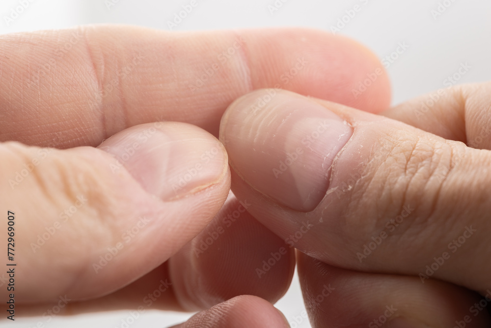 Ridged fingernail of a thumb finger of a man with horizontal ridges on white background. Ridged fingernail of a thumb finger of a man with horizontal ridges on white background.