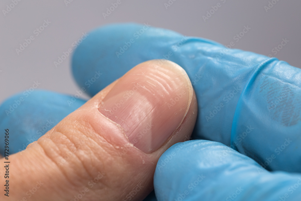Doctor examining a ridged fingernails with vertical and horizontal ridges. Nails problems Stock