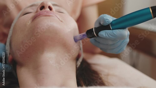 Close-up of a professional dermatologist using a derma pen on a patient's face during a microneedling procedure to rejuvenate the skin.