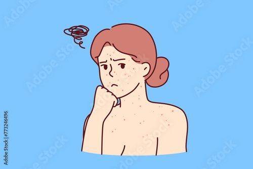 Woman with allergic rash on face and body looks sadly at screen, needing help of dermatologist. Rash covering girl skin due to poor hygiene or lack of vitamins that strengthen immune system