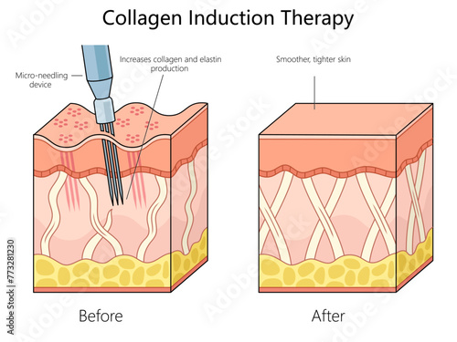 skin structure before and after collagen induction therapy using a micro-needling device for enhanced skin texture diagram schematic vector illustration. Medical science educational illustration