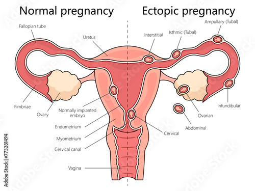 Human normal and ectopic pregnancies with labeled female reproductive system structure diagram hand drawn schematic vector illustration. Medical science educational illustration