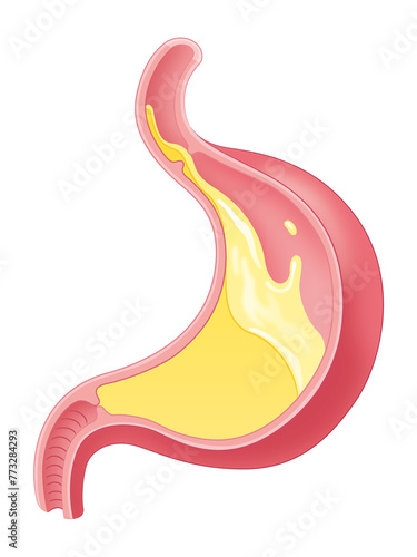 胃酸が逆流している胃 photo