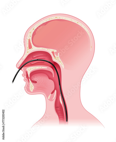 鼻から入れる胃カメラ photo