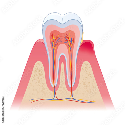 歯周病の歯の断面