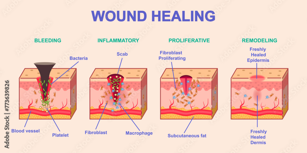 Wound healing process. Medical infographics or diagram with stages or phases of skin regeneration after injury. Bleeding, Inflammation, Proliferation and Remodeling. Cartoon flat vector illustration - obrazy, fototapety, plakaty 