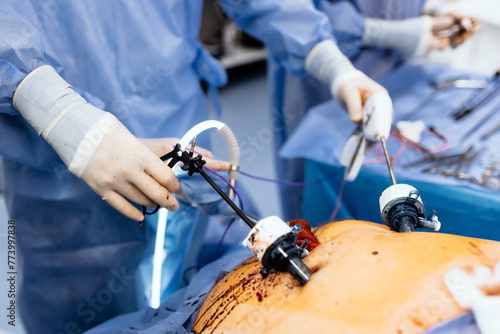 Professional surgeons in the operating room. Instrument for laparoscopic surgery. A surgeon performs laparoscopic gastric surgery in the operating room.