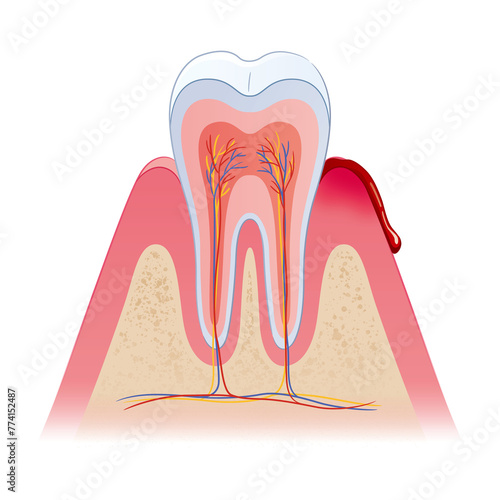 歯周病の断面図 photo
