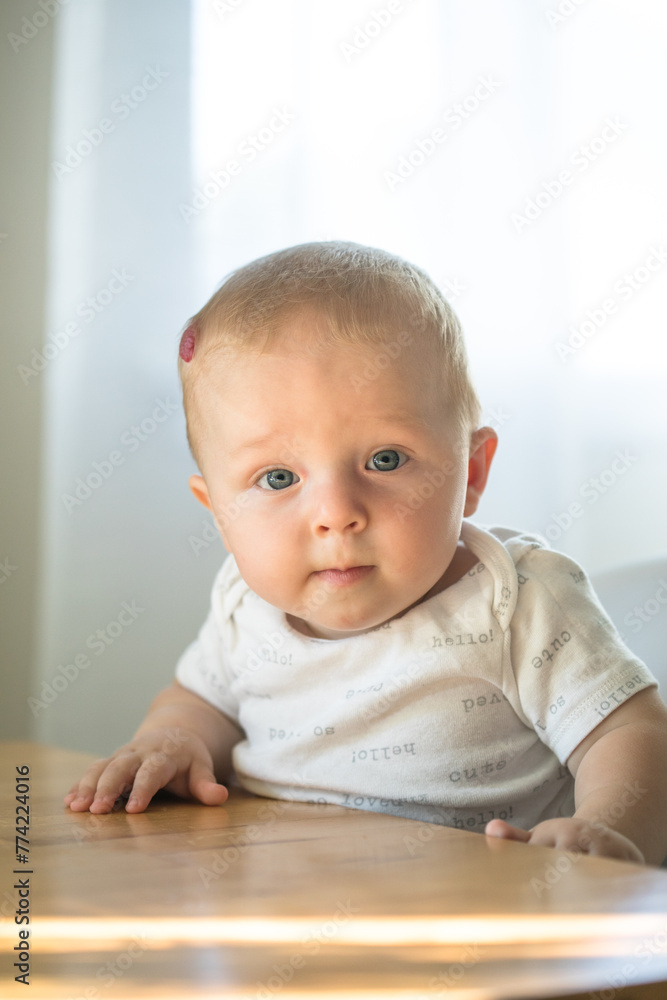 Baby boy with Hemangioma on head sitting in high chair ready for eating Baby boy with Hemangioma on head sitting in high chair ready for eating
